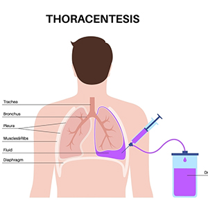 Thoracentesis in Hyderabad