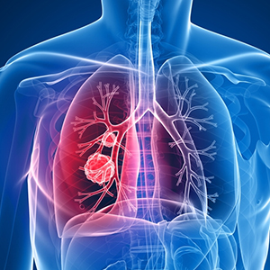 Lung Cancer Hospitals in Hyderabad